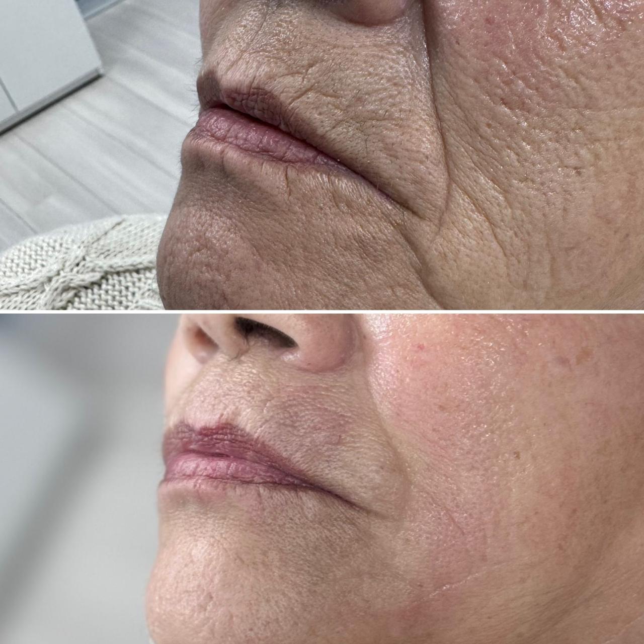 antes y despues CG STYLER SURCO NASOGENIANO